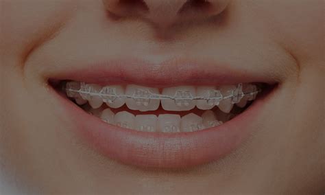 Facts About Clear Braces - Stoll Family Dentistry in Parker