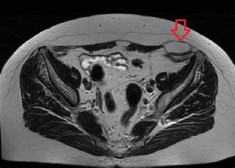 Can A Ct Scan Miss A Hernia - hideawaytips