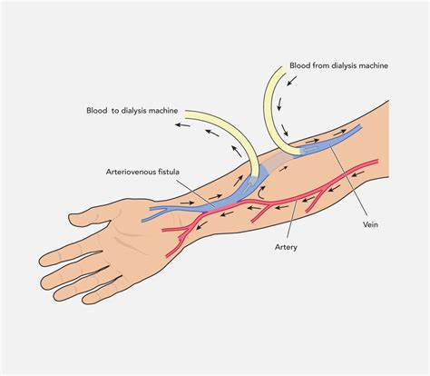 Arteriovenous Fistula (AVF) - CVSKL