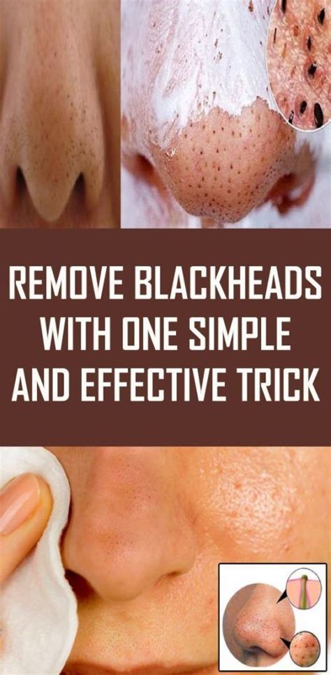 Pin on blackheads remedies