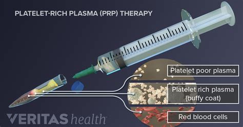 Platelet-Rich Plasma Injection Procedure