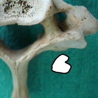 Showing bilateral Accessory Foramen Transversarium (AFT) & incomplete ...