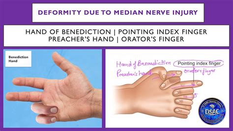 Hand of Benediction | Pointing index finger | Median nerve injury ...