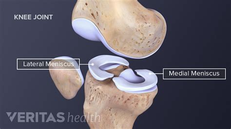 Understanding Meniscus Tears