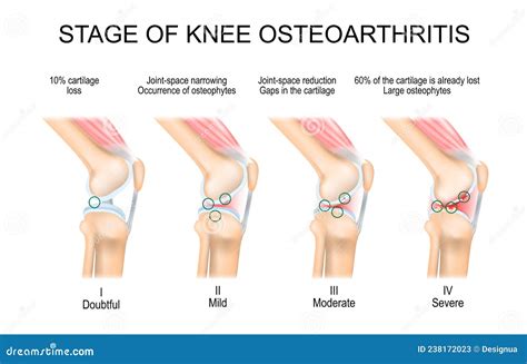 Knee Osteoarthritis Stages stock vector. Illustration of bone - 238172023