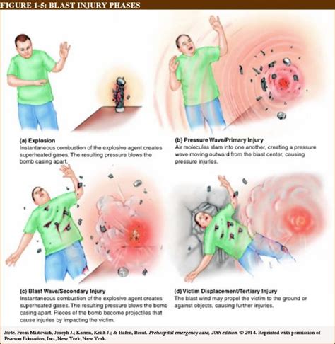 Blast-related injuries classification (via westernschools.com ...