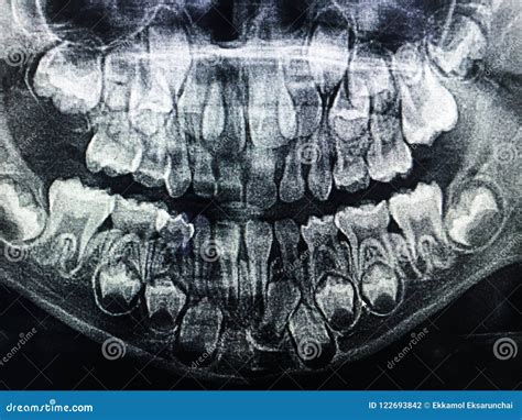 Radiografía Dental Del Niño 6 Años, Todos Los Dientes De Bebé En La ...