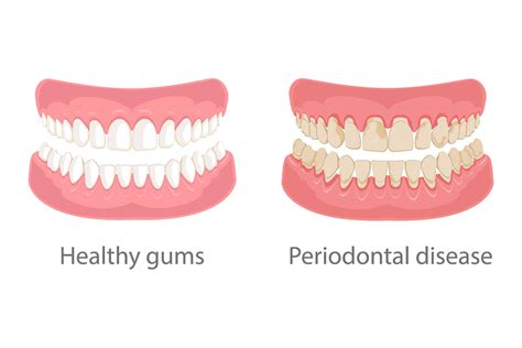 How Does a Periodontist Fix Receding Gums? | ABQ