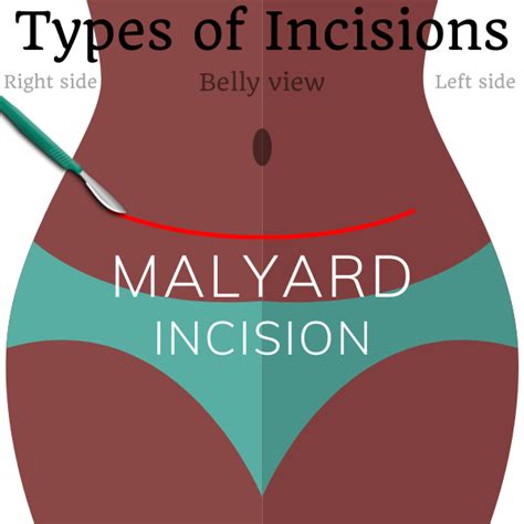 Types of surgical incisions - SterilizationAunty