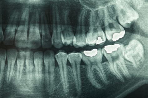 How Safe Are Dental X-Rays? What's involved and why they're performed.