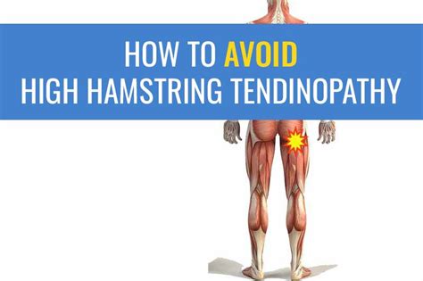 5 Tips for avoiding High Hamstring Tendinopathy in Runners | Sports ...