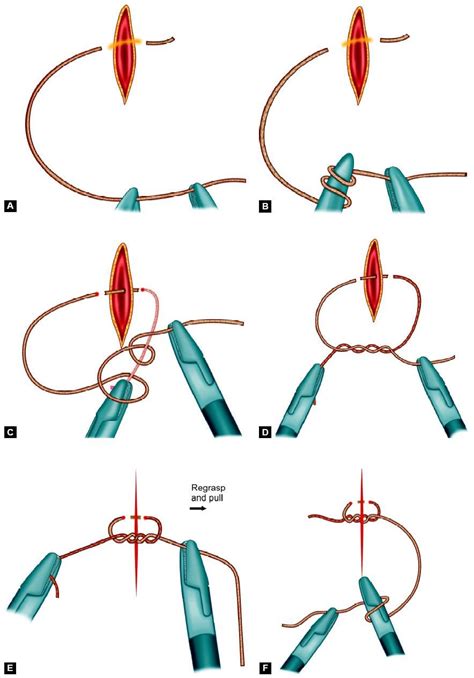 Laparoscopic Intracorporeal Suturing