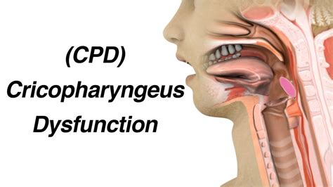 Cricopharyngeus Dysfunction (CPD) Causing Dysphagia or Trouble ...