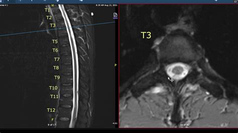 Thoracic Spine Mri Multiple Sclerosis