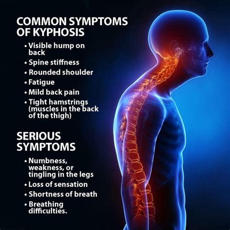 Kyphosis Symptoms, Treatment | Florida Orthopaedic Institute