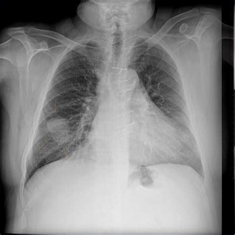 Solitary Pulmonary Nodule-CT - Sumer's Radiology Blog