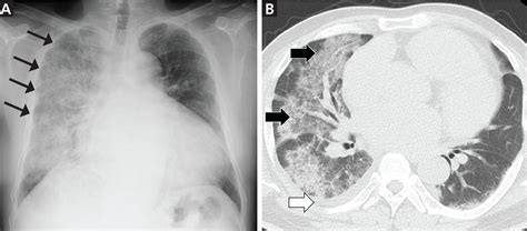 Pulmonary Edema Chest X Ray