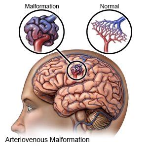 Arteriovenous Malformation (Aftercare Instructions)