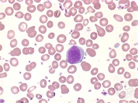 Myelofibrosis: peripheral blood - 4.