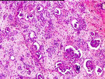 Kidney: Nephroblastoma (Wilms tumor)