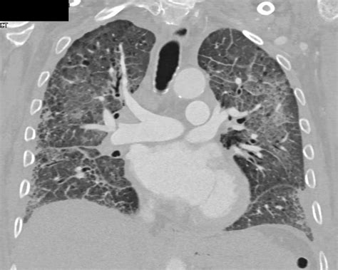 Pulmonary Edema in Patient with Interstitial Lung Disease - Chest Case ...