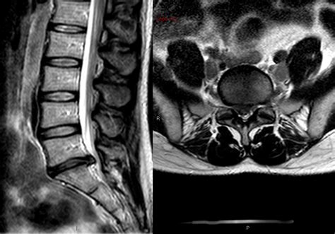 Cauda Equina Syndrome – OrthoSHO