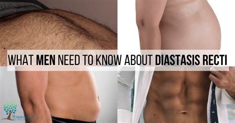 What Men Need to Know about Diastasis Recti - The Tummy Team Online The ...