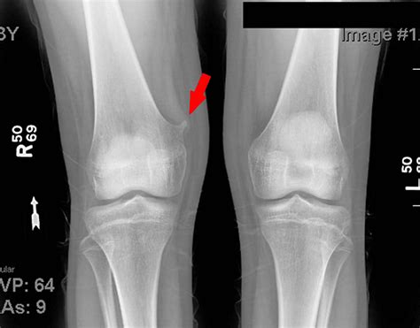 Spontaneous Resolution of an Osteochondroma | Cureus