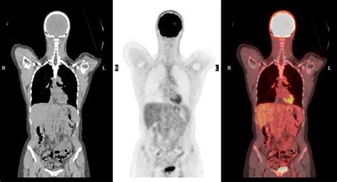 PET Scan Patient Education - Brigham and Women's Hospital