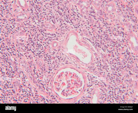 Histology micrograph of renal failure, showing interstitial nephritis ...