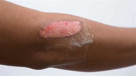 Burns: Types, Symptoms, and Treatments