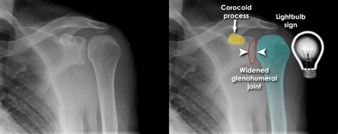 Trauma X-ray - Upper limb gallery 1 - Shoulder dislocation - Posterior