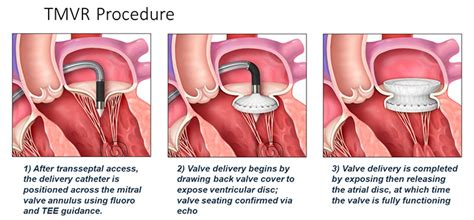 First Transfemoral Mitral Valve Replacement Performed by Heart Team ...