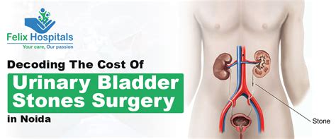 Cost Of Urinary Bladder Stones Surgery in Noida