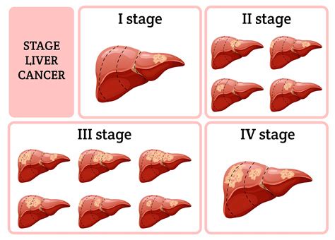 10 Treatments for Liver Cancer - Facty Health