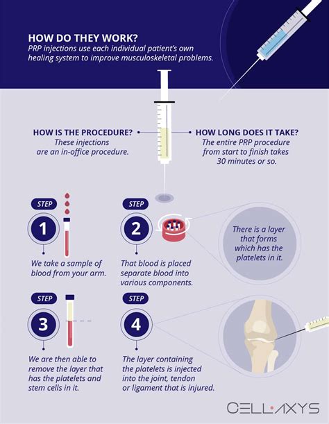 Platelet-Rich Plasma (PRP) Injections Recovery Time - Cellaxys