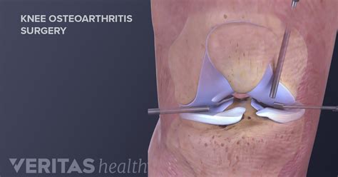 Knee Surgery for Arthritis