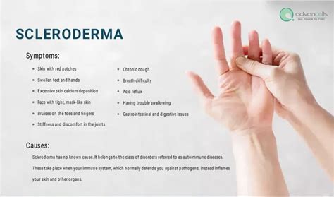 Scleroderma: Signs and Symptoms, Types, Causes, and Treatment