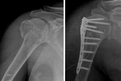 63 year old female with two part surgical neck fracture due to slip ...