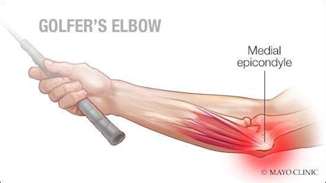 Medial epicondylitis A.K.A Golfer's elbow: Orthopedic Center for Sports ...