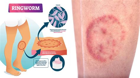 Ringworm Symptoms, Causes, and Treatments Never to Ignore