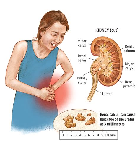 Kidney Stones in Children and Adolescents | Adolescent Medicine | JAMA ...