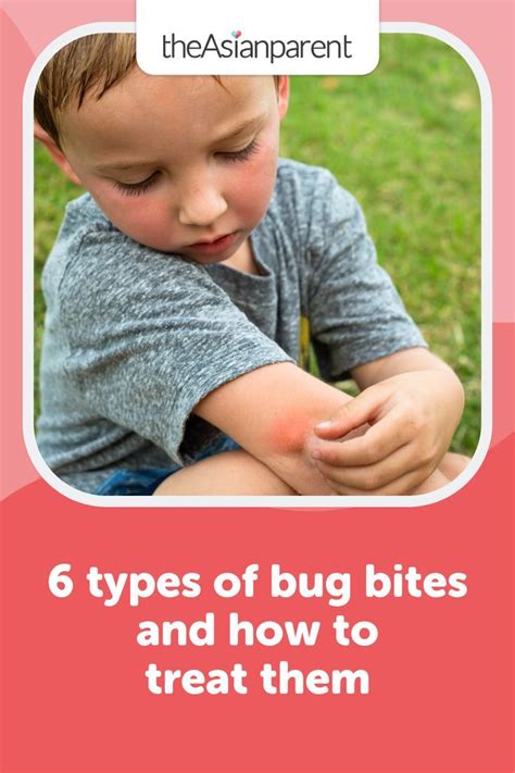 6 types of bug bites and how to treat them in 2022 | Types of bug bites ...