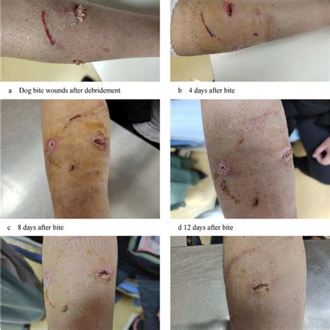 Macroscopic view of wound healing process after dog bite. Note: The ...