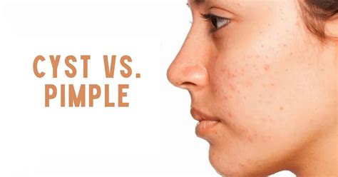 Clearing the Confusion: Cyst vs. Pimple - Expert Insights Revealed