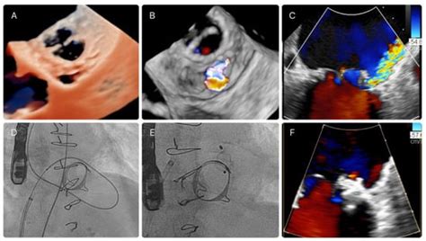 THE CHRONIC LEAKY MITRAL VALVE • MyHeart