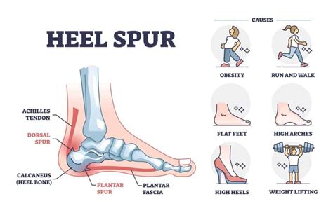 Heel Spur Treatment by a Physical Therapist including Exercises