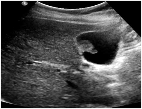 Ultrasound demonstrating a 2-cm pedunculated gallbladder polyp ...