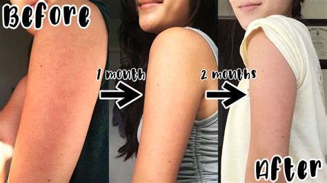 NEW: HOW I CLEARED MY CHICKEN SKIN/KP (KERATOSIS PILARIS) | 2 Month ...