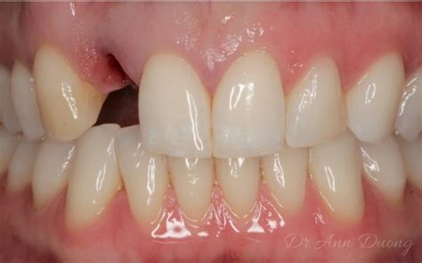 Bonded Bridges Before and After - Case Studies by Preventive Dentistry